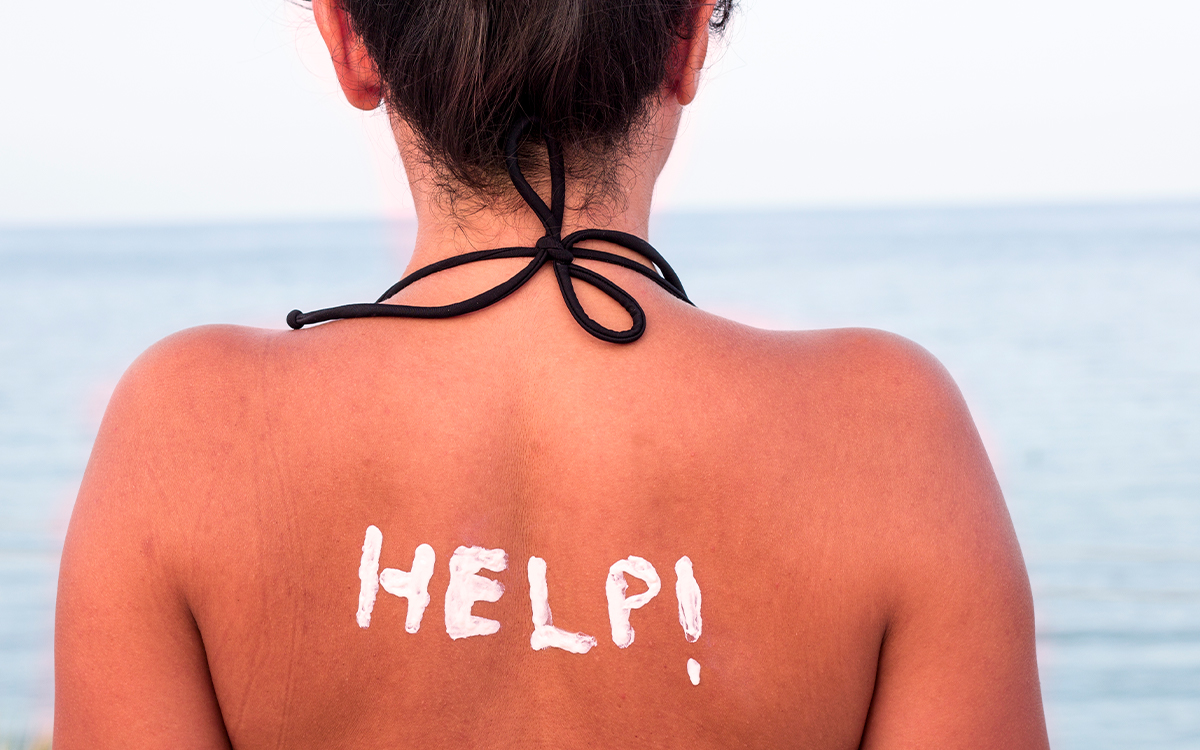 Ein vom Sonnenbrand geröteter Rücken, auf dem mit Sonnencreme "Help" steht.